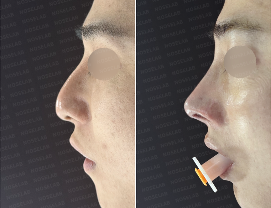 Left lateral view comparison showing preoperative nasal profile on the left and immediate postoperative appearance on the right after septal reconstruction and nasal tip support.