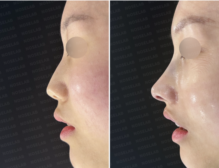 Before and immediately after surgery lateral view showing straightened nasal bridge and natural elevation of the drooping nasal tip following implant-free closed rhinoplasty with rib cartilage reconstruction.