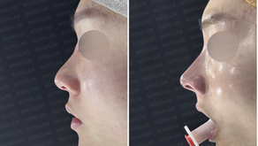 Before and immediately after surgery left lateral view comparison showing increased nasal bridge height and improved nasal tip projection following primary male rhinoplasty.