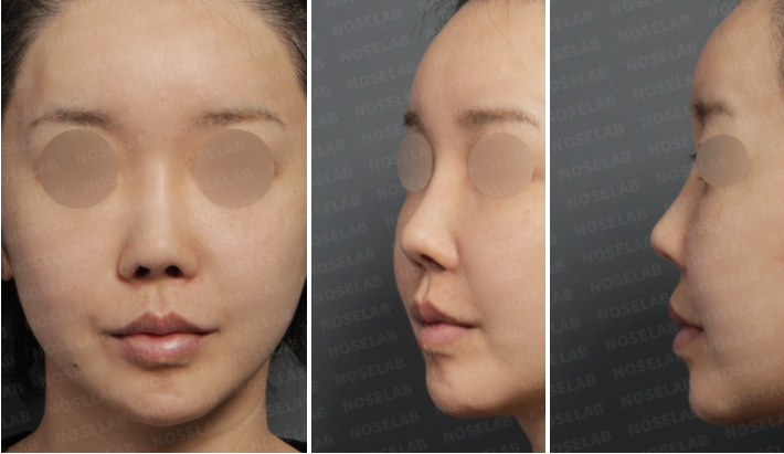Preoperative frontal, left oblique, and left side views before short upturned nose revision rhinoplasty.
