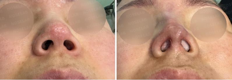 Before surgery (left), after surgery (right)
