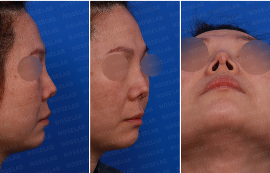 Design consultation photos: right side, oblique side, and nostril view before contracted nose correction surgery