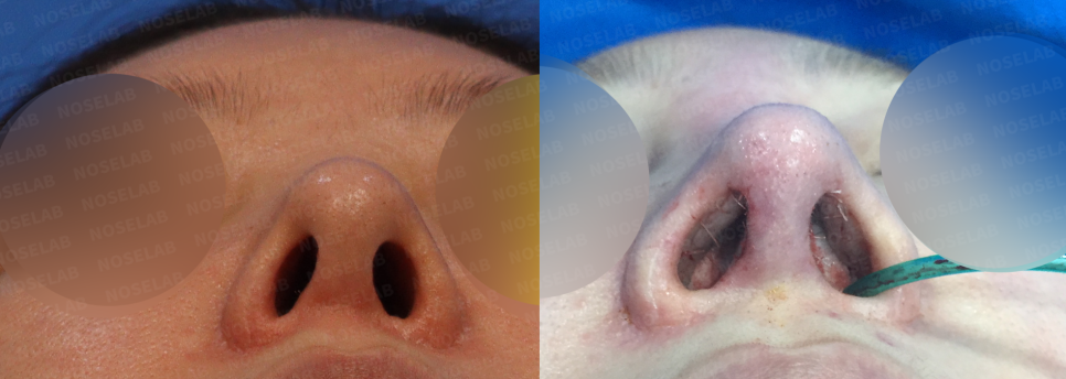 Basal view comparison demonstrating balanced nostril appearance and columellar refinement following corrective surgery