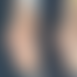 Oblique view before and after Revision Rhinoplasty Korea, early postoperative result.