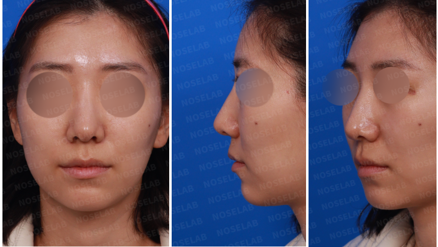 Pre-operative design consultation photos for autologous rib cartilage nose surgery – frontal view, left side view, and oblique side view of the patient's face.