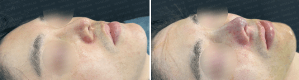 Oblique angle