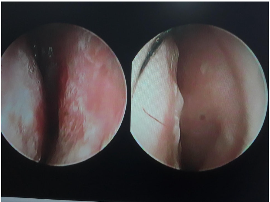 Endoscopic nasal images showing deviated nasal septum before functional rhinoplasty.