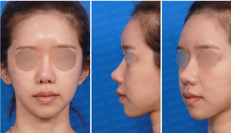 Preoperative frontal and oblique views in revision rhinoplasty for deviated nose Korea