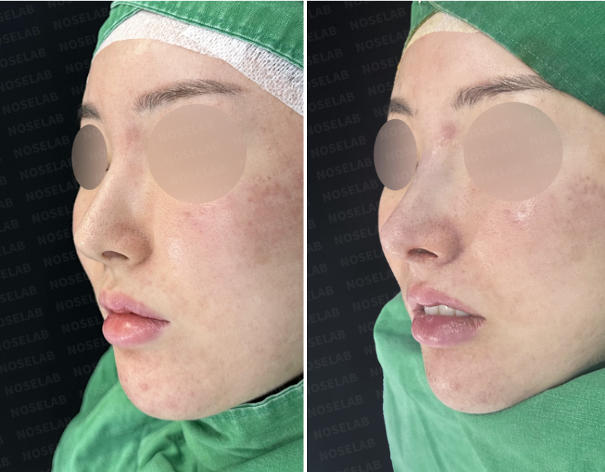 Before and immediately after Feminine Rhinoplasty: 45-degree oblique view comparison showing refined nasal tip, balanced projection, and natural feminine contour.