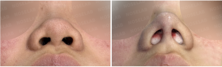 Before and immediately after closed rhinoplasty nostril view showing reduced nostril show, improved columella position, and balanced nostril shape following autologous rib cartilage reconstruction.