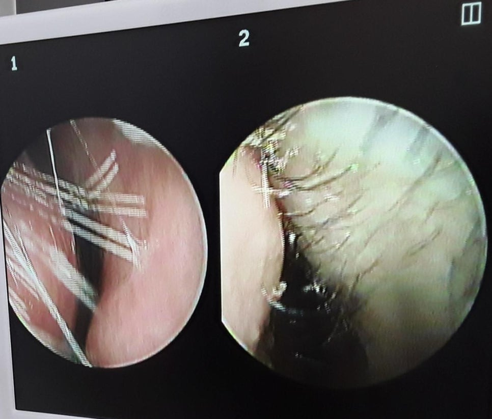 Intranasal endoscopy photograph 1. right 2. left