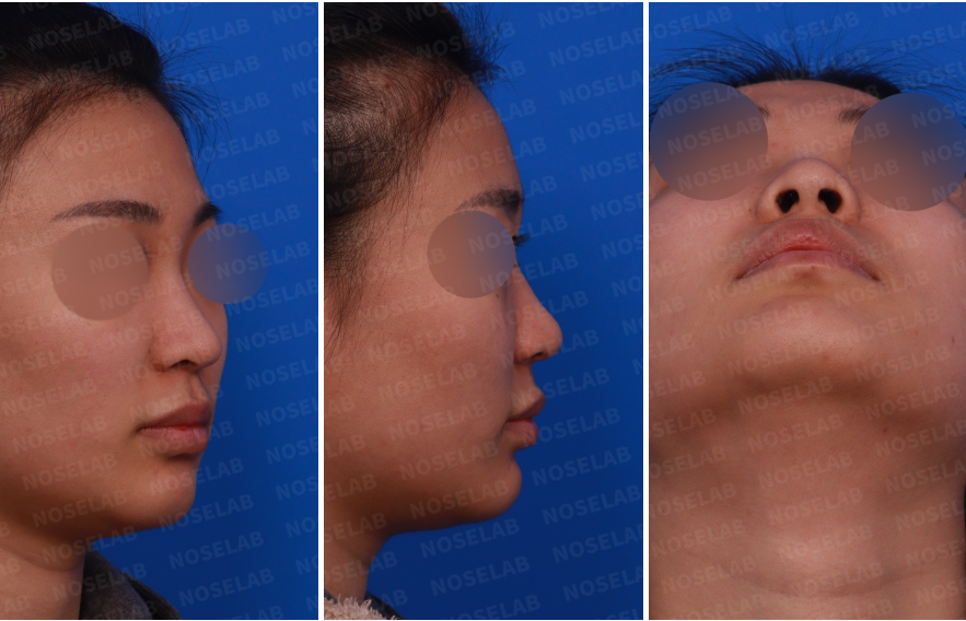 Pre-surgery right side, oblique side, and nostril view of a patient with a bulbous nasal tip, mild dorsal hump, and slight nostril asymmetry before closed straight-line rhinoplasty using autologous rib cartilage.