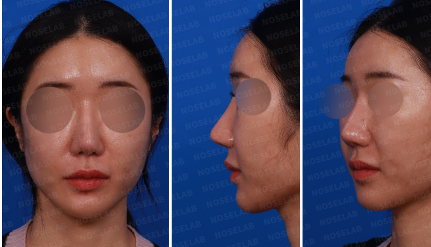 Preoperative design consultation photos showing frontal view, left side profile, and left oblique 45-degree angle before nostril reconstruction surgery (closed rhinoplasty)