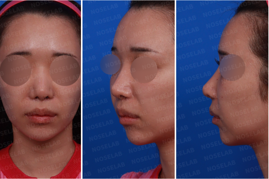 Nostril asymmetry correction Korea preoperative frontal, left side, and oblique views