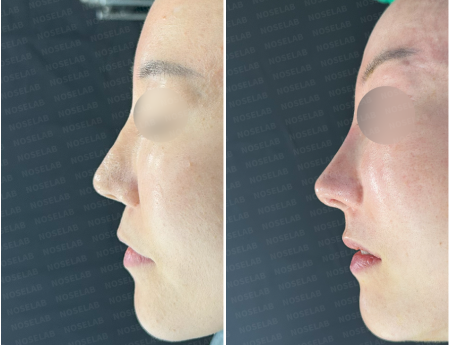 Right side view before (left) and immediately after (right) revision rhinoplasty with autologous rib cartilage