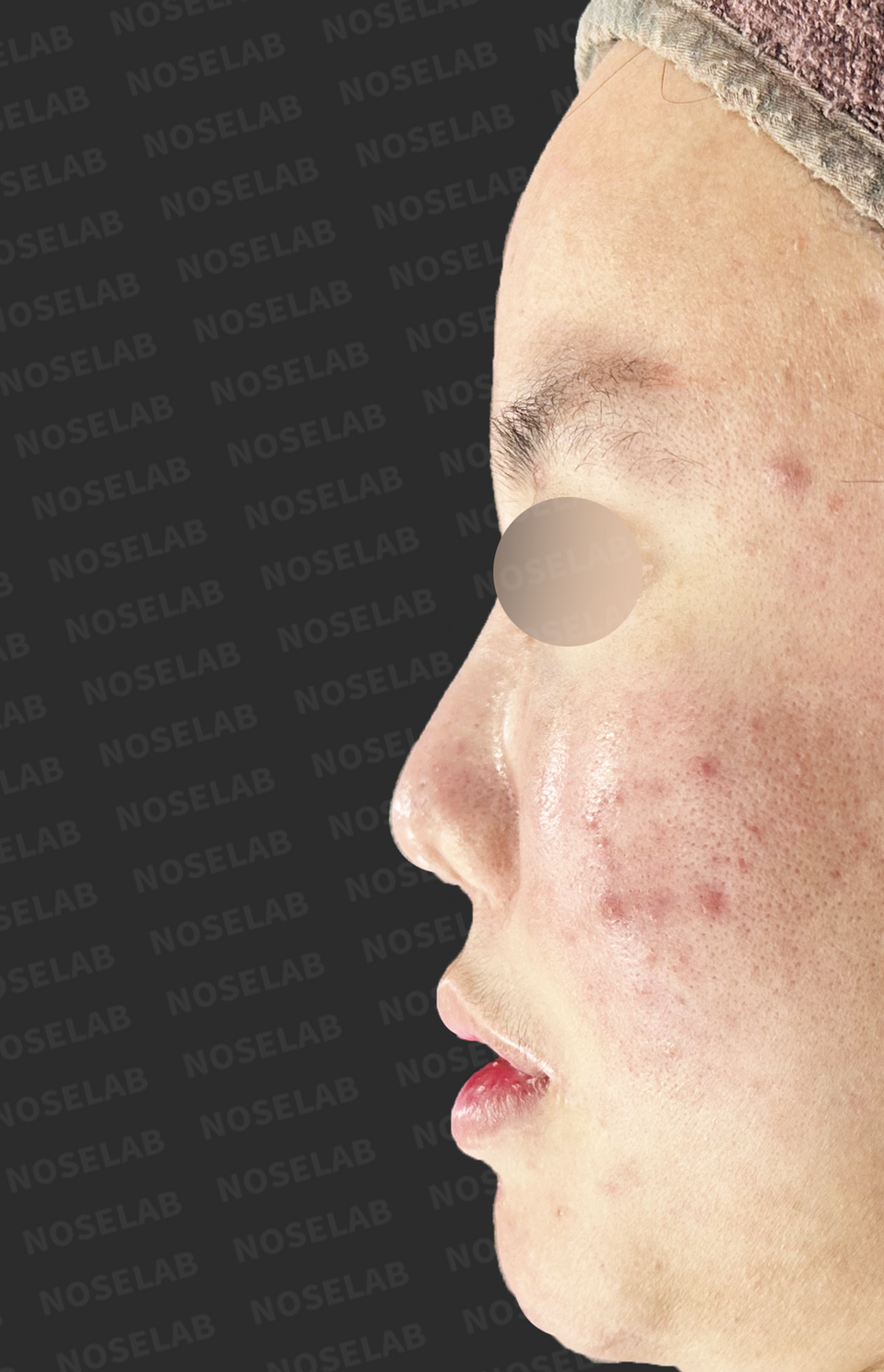 Before surgery: left profile.