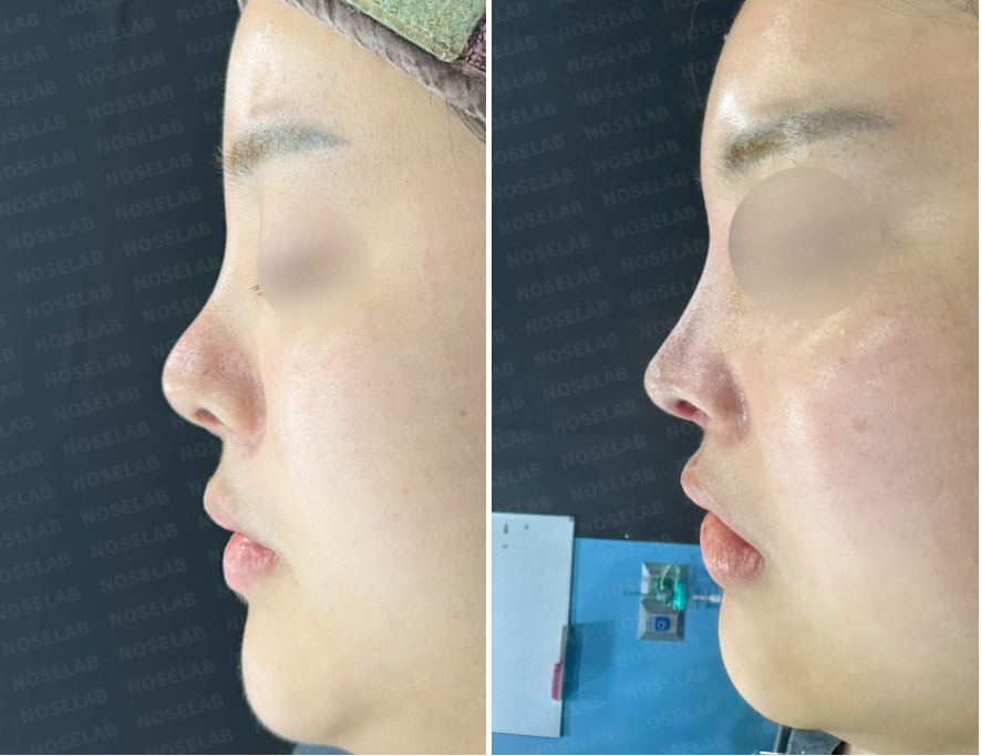Side View Before and Immediately After Donor Rib Cartilage Revision – Wide Nasal Bridge Narrowing and Tip Rotation Correction