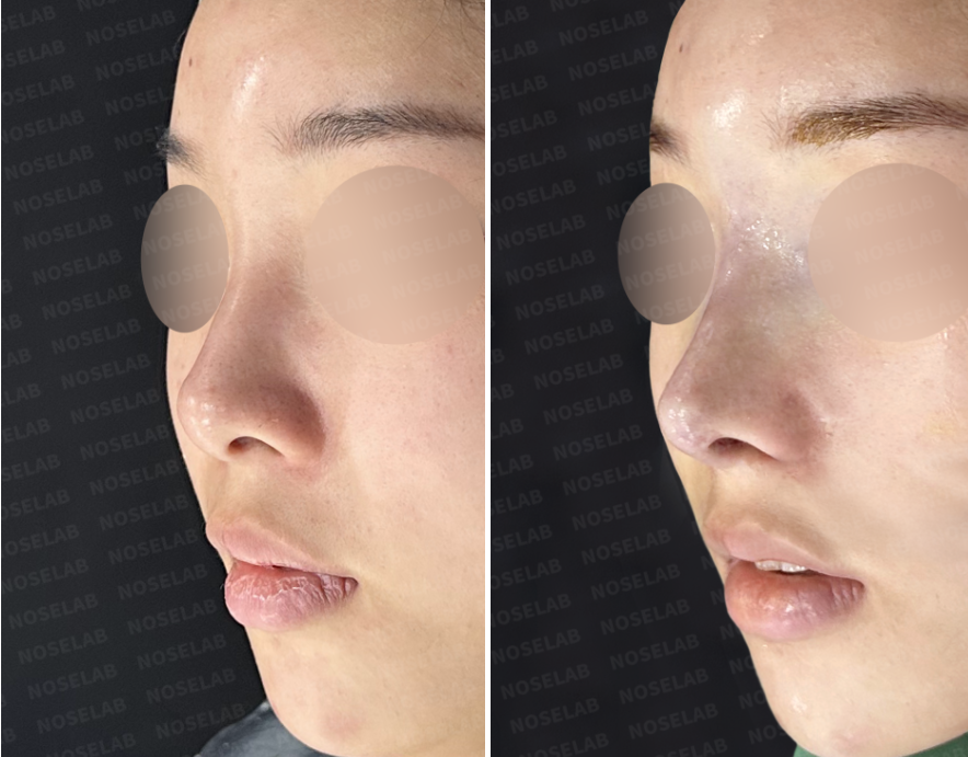 Before and immediately after surgery left oblique view comparison showing refinement of the nasal bridge contour and improved nasal tip projection following primary rhinoplasty.