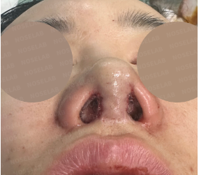 Photo of the nostrils taken right after the surgery
