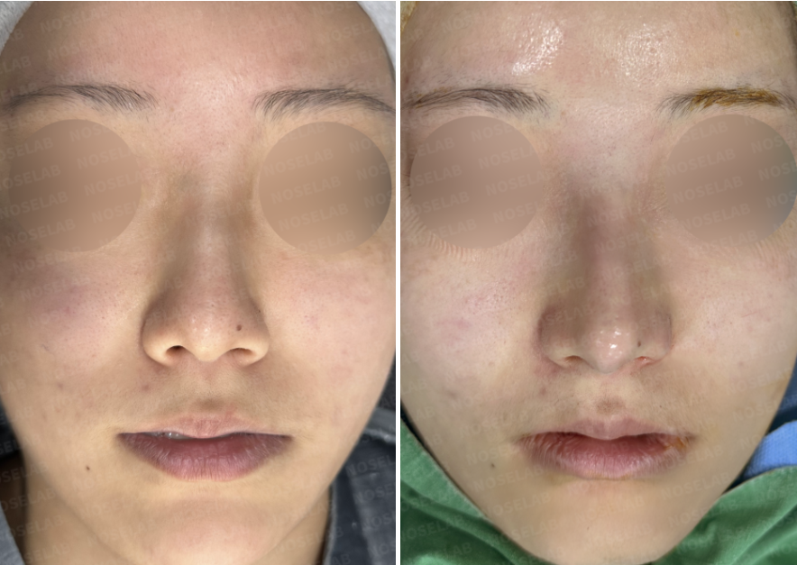 Before and immediately after surgery frontal view showing removal of nasal fillers and correction of a drooping nasal tip and dorsal hump through closed rhinoplasty with autologous rib cartilage.