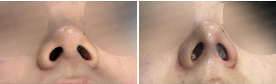 Before and immediately after surgery nostril view showing improved nostril symmetry and nasal tip support following nasal filler removal and closed rhinoplasty with autologous rib cartilage.
