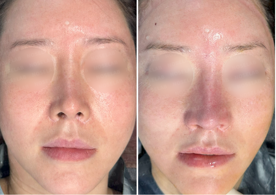 Before and immediately after revision rhinoplasty: frontal view comparison showing nasal symmetry correction and tip refinement.
