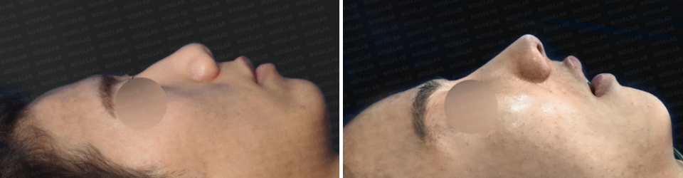 Side profile view before and after Closed Rhinoplasty Korea, showing correction of nasal hump and improved columella lowering.