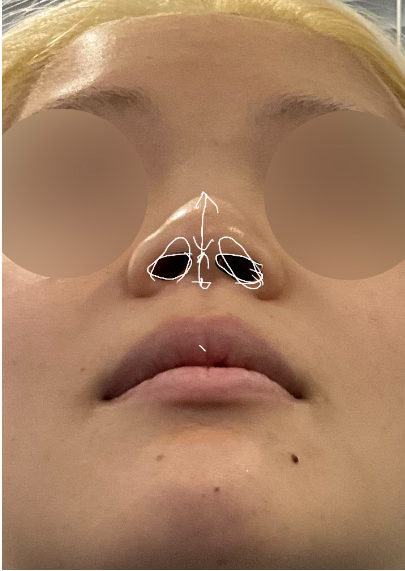 Nostril preoperative design photo showing wide nasal base, asymmetrical alar size, and uneven nostril shape.