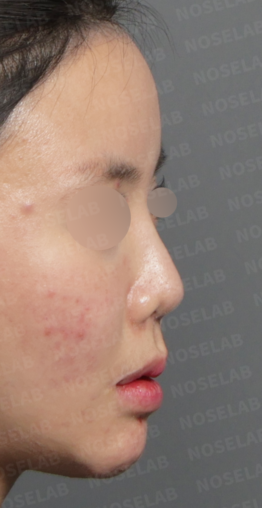 Preoperative consultation: right profile.