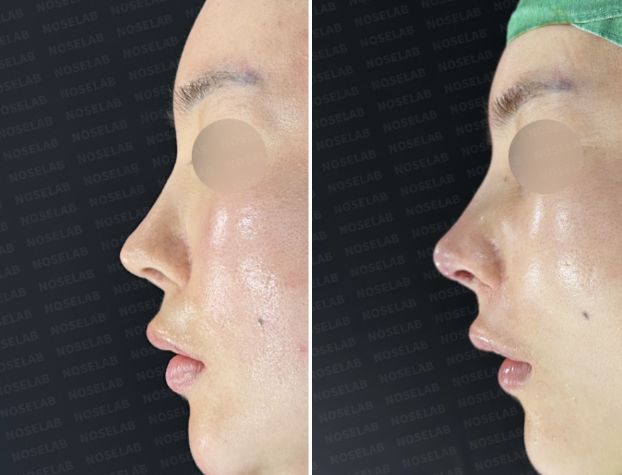 Before and immediately after surgery lateral view showing correction of a depressed mid-dorsum and improved nasal structural support after closed revision rhinoplasty using autologous rib cartilage.