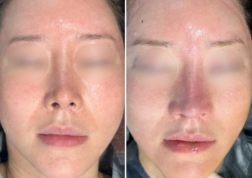 Before and after photos of Upturned Nose Correction surgery: frontal view comparison (Left: before surgery, Right: immediately after surgery).