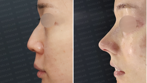 Before and immediately after surgery lateral view showing smoothing of the dorsal hump, elevation of the nasal tip, and creation of a balanced nasal profile following closed rhinoplasty with rib cartilage and osteotomy.