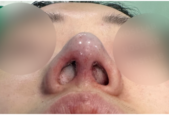 Photo of the nostrils after surgery.