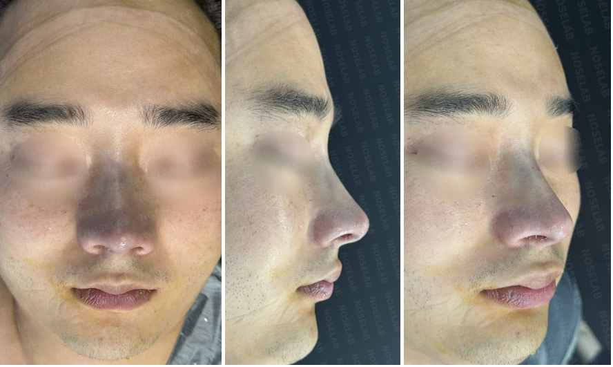 Photos immediately after surgery – combined frontal, side, and oblique side views after Male Rhinoplasty Korea with closed rhinoplasty, showing refined nasal tip, higher bridge, and improved masculine balance.
