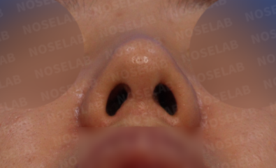 ostril view before long nose correction rhinoplasty, showing nostril asymmetry and tilted columella