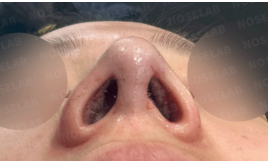 Immediately after surgery – nostril view showing improved symmetry and internal nasal structure following bulbous tip correction.