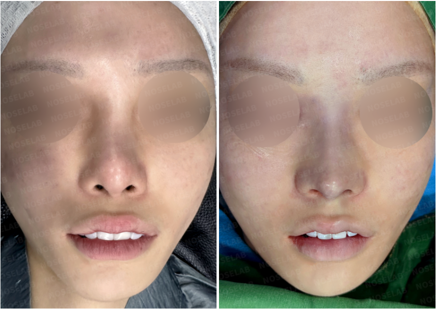 Before and immediately after surgery frontal view showing lowering of the high radix and improved nasal alignment following revision closed rhinoplasty with rib cartilage reconstruction.