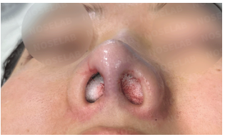Immediately after customized nasal reconstruction – frontal, oblique side, and side views showing lowered nasal bridge, refined tip, and improved facial harmony.