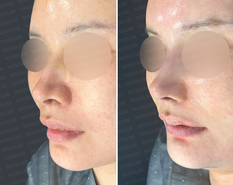 Oblique before-and-after view after Post-Traumatic Rhinoplasty Korea showing contour correction.