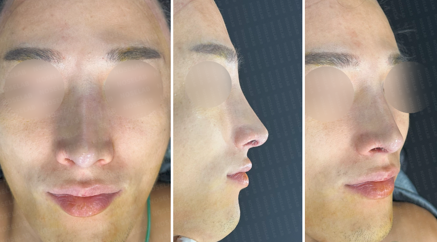 Immediately after surgery photos of a male patient: frontal, side, and oblique side views showing correction of crooked nose, elevated nasal bridge with silicone implant, and improved nasal symmetry.