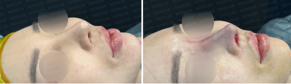 45-degree oblique before and after long nose correction, highlighting smoother nasal contour and refined tip.