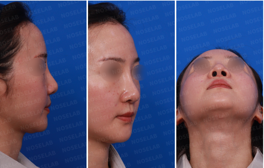 Preoperative consultation photos for droopy nasal tip correction – right side, right oblique, and nostril views.