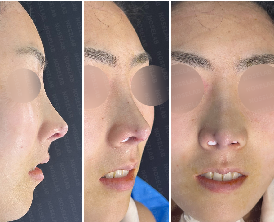 Photos after the surgery. 90° angle | 45° angle | Frontal view