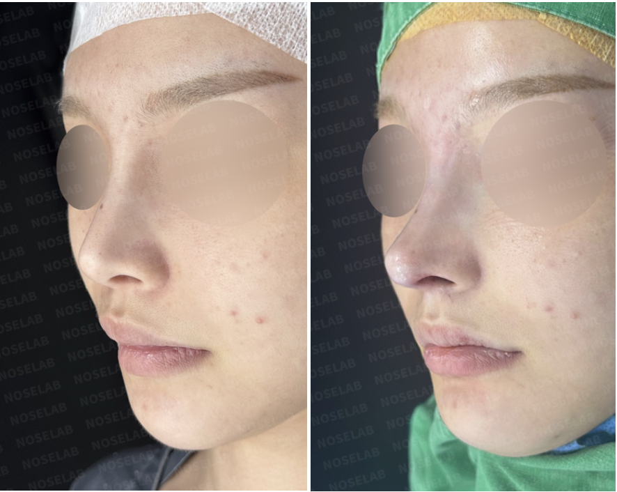 Oblique view before and after High Radix Rhinoplasty Korea showing refined tip and dorsum.