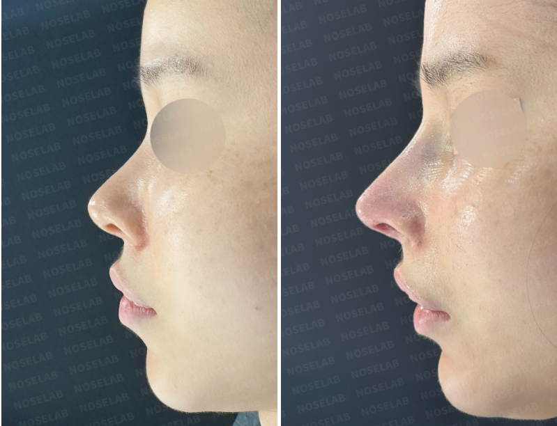 Side view photos showing the nose before surgery (left) and immediately after surgery (right).