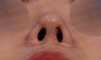 Revision rhinoplasty Korea – preoperative nostril view showing asymmetry of upturned and deviated nose