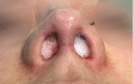 Photo of the nostrils after surgery.