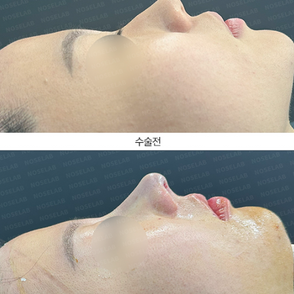 Upturned nose correction Korea preoperative and postoperative side profile comparison