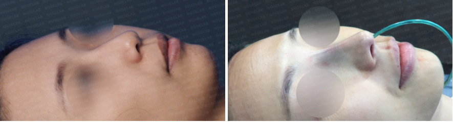 efore and immediately after split nasal tip correction surgery: oblique side view comparison.