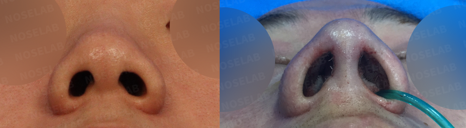 closed rhinoplasty Korea before and after nostril view – bulbous and short nose correction with nostril balance improvement (Left: before surgery, Right: immediately after surgery)